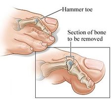 HAMMER TOE SPECIALISTS